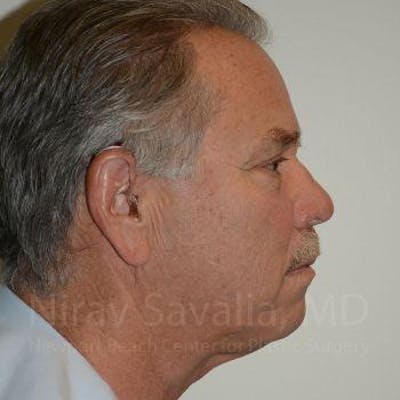 Chin Implants Before & After Gallery - Patient 1655711 - After