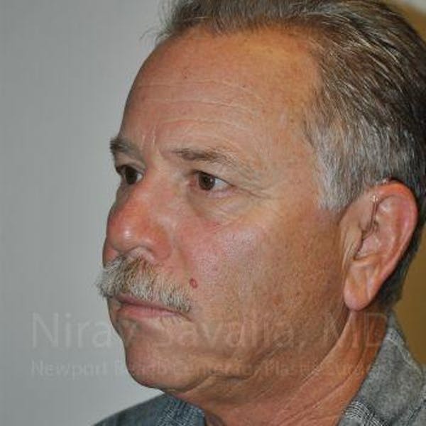 Chin Implants Before & After Gallery - Patient 1655711 - Before