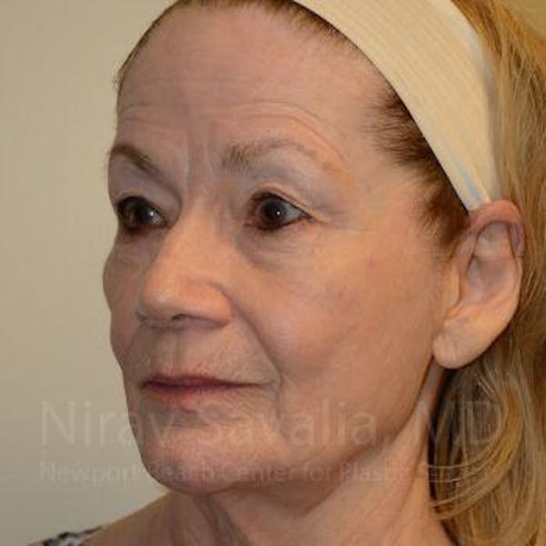 Mommy Makeover Before & After Gallery - Patient 1655710 - Before