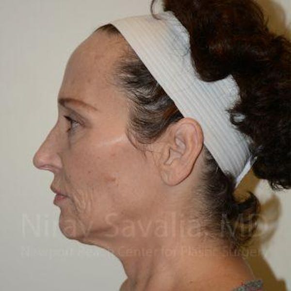 Oncoplastic Reconstruction Before & After Gallery - Patient 1655712 - Before