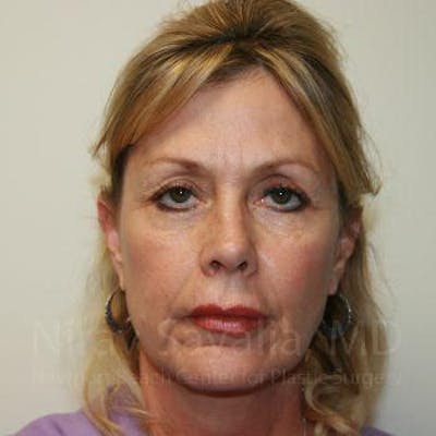 Brow Lift Before & After Gallery - Patient 1655714 - Before