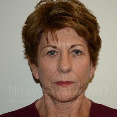 Chin Implants Before & After Gallery - Patient 1655716 - After