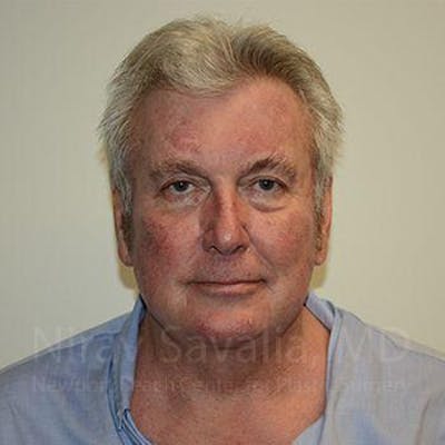 Chin Implants Before & After Gallery - Patient 1655717 - After