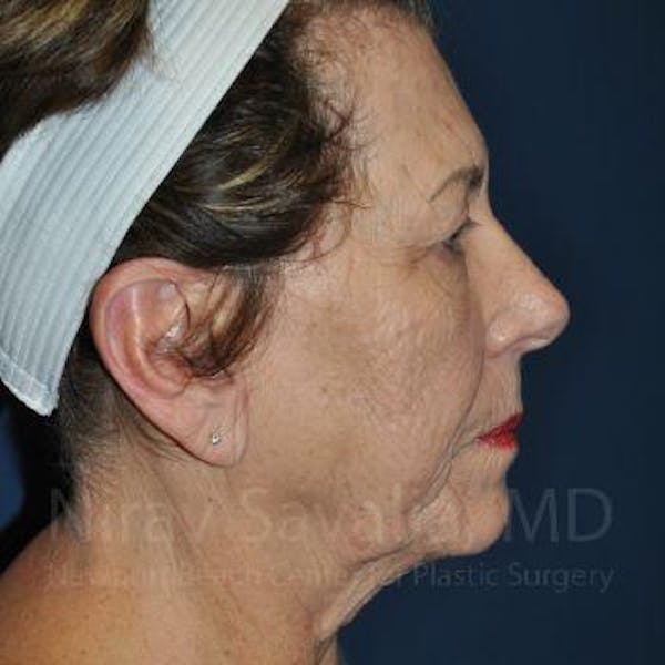 Chin Implants Before & After Gallery - Patient 1655716 - Before