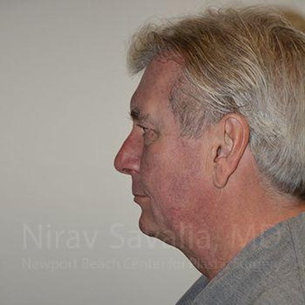 Chin Implants Before & After Gallery - Patient 1655717 - Before