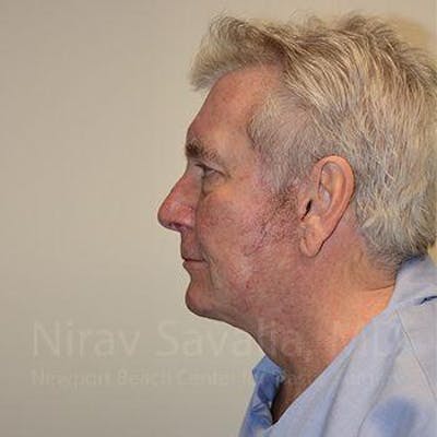 Chin Implants Before & After Gallery - Patient 1655717 - After