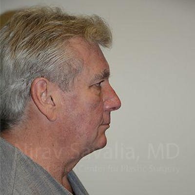 Chin Implants Before & After Gallery - Patient 1655717 - Before