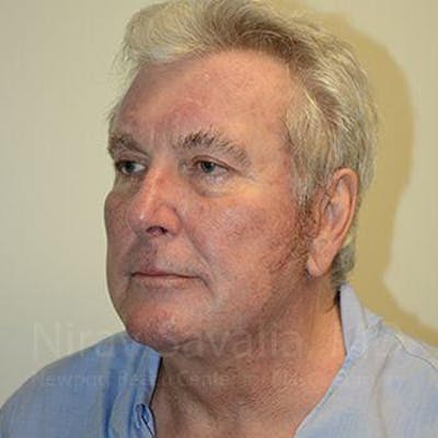 Chin Implants Before & After Gallery - Patient 1655717 - After