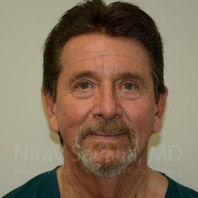 Oncoplastic Reconstruction Before & After Gallery - Patient 1655720 - Before