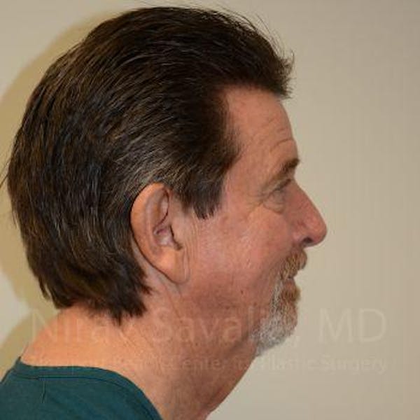 Chin Implants Before & After Gallery - Patient 1655720 - Before