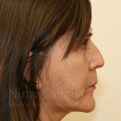 Chin Implants Before & After Gallery - Patient 1655721 - After