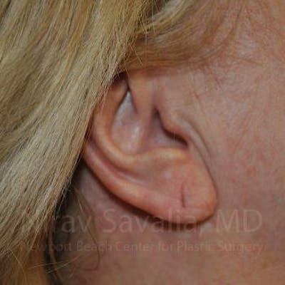 Chin Implants Before & After Gallery - Patient 1655722 - Before