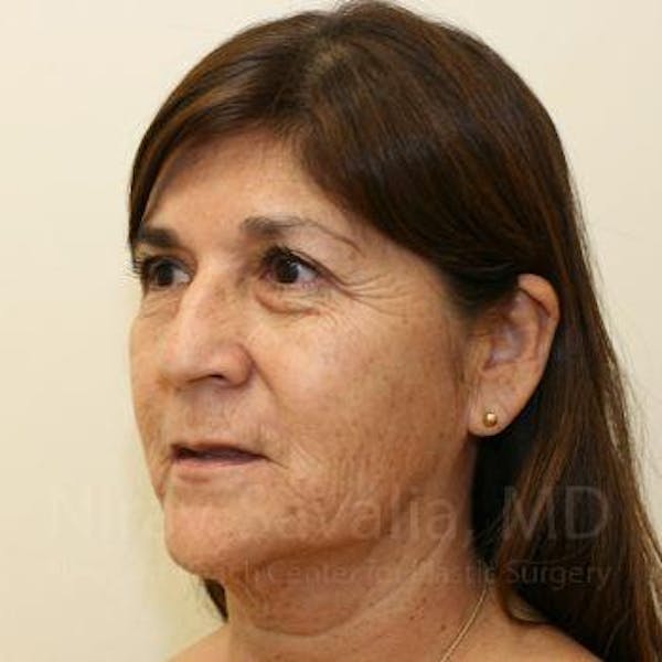 Chin Implants Before & After Gallery - Patient 1655721 - Before