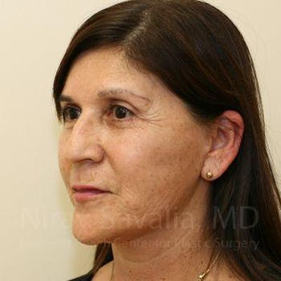 Chin Implants Before & After Gallery - Patient 1655721 - After