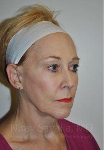 Brow Lift Before & After Gallery - Patient 1655725 - Before