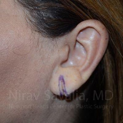 Oncoplastic Reconstruction Before & After Gallery - Patient 1655724 - Before