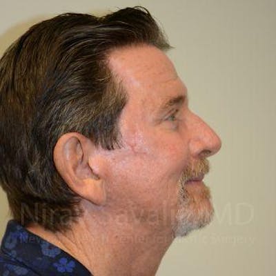 Chin Implants Before & After Gallery - Patient 1655726 - After