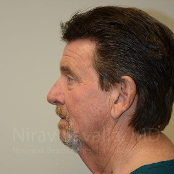 Chin Implants Before & After Gallery - Patient 1655726 - Before