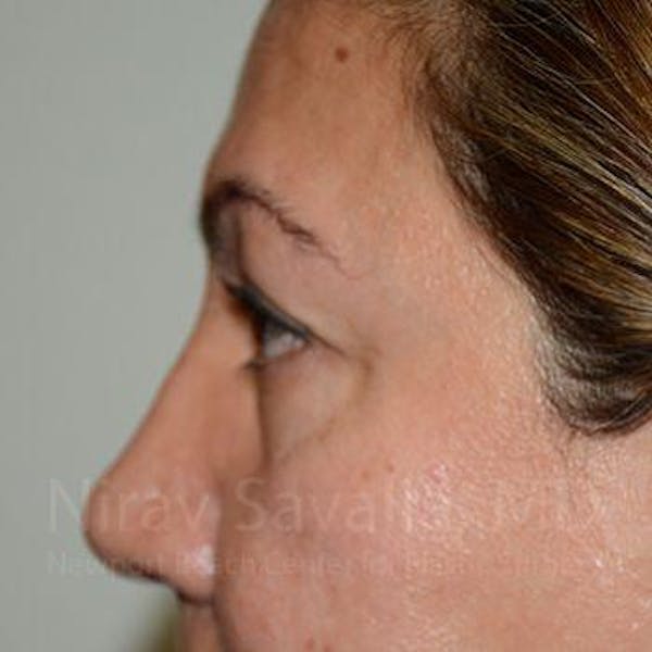 Brow Lift Before & After Gallery - Patient 1655728 - Before