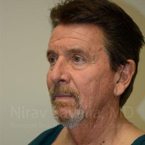 Chin Implants Before & After Gallery - Patient 1655726 - Before
