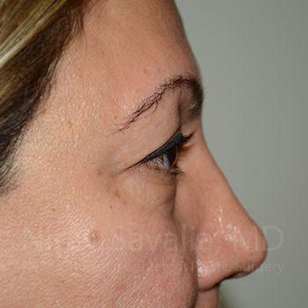 Oncoplastic Reconstruction Before & After Gallery - Patient 1655728 - Before