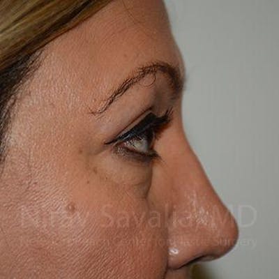 Mommy Makeover Before & After Gallery - Patient 1655728 - After