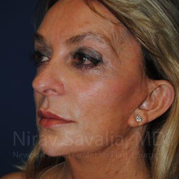 Oncoplastic Reconstruction Before & After Gallery - Patient 1655730 - Before