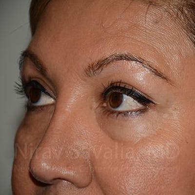 Oncoplastic Reconstruction Before & After Gallery - Patient 1655728 - After