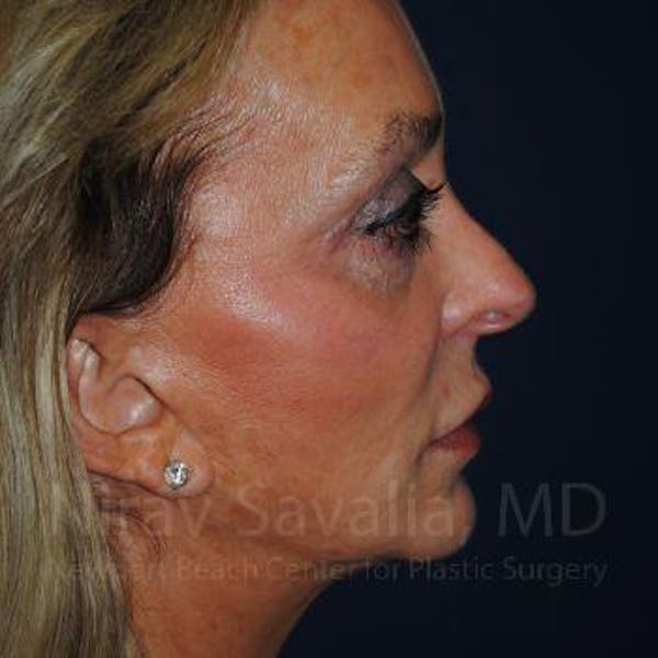 Chin Implants Before & After Gallery - Patient 1655730 - Before