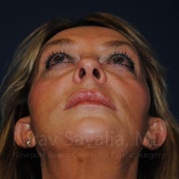 Oncoplastic Reconstruction Before & After Gallery - Patient 1655730 - Before