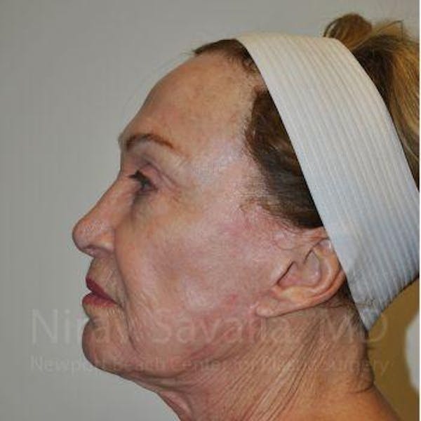 Chin Implants Before & After Gallery - Patient 1655786 - Before