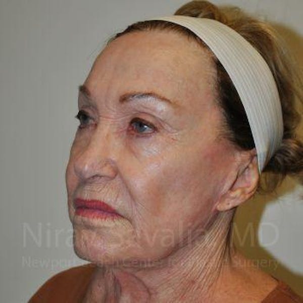 Chin Implants Before & After Gallery - Patient 1655786 - Before