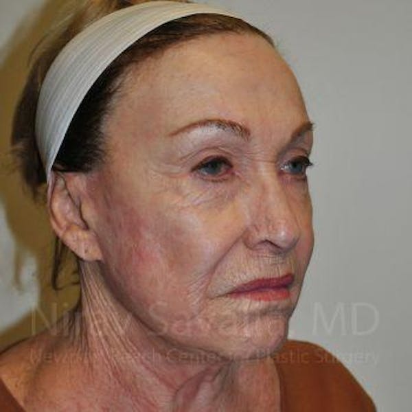 Chin Implants Before & After Gallery - Patient 1655786 - Before