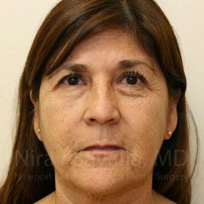 Chin Implants Before & After Gallery - Patient 1655793 - Before