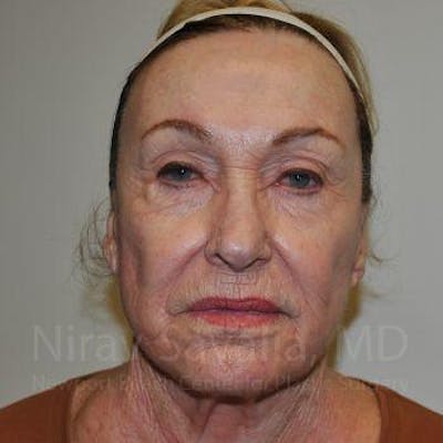 Chin Implants Before & After Gallery - Patient 1655799 - Before