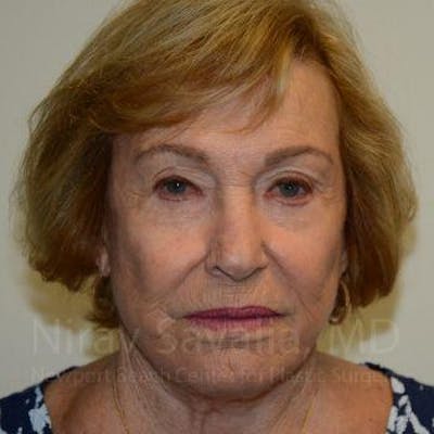Brow Lift Before & After Gallery - Patient 1655799 - After