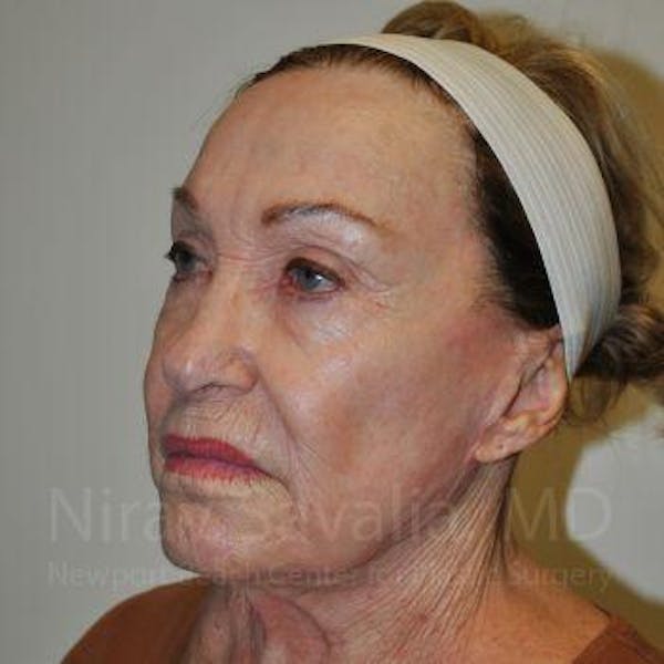 Brow Lift Before & After Gallery - Patient 1655799 - Before