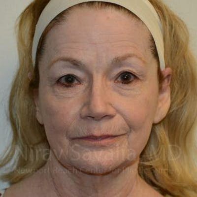 Brow Lift Before & After Gallery - Patient 1655803 - Before