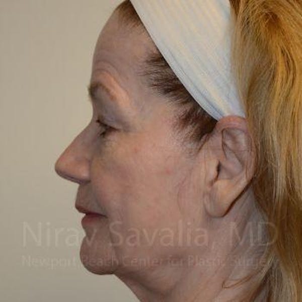 Oncoplastic Reconstruction Before & After Gallery - Patient 1655803 - Before