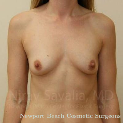 Chin Implants Before & After Gallery - Patient 1655442 - Before