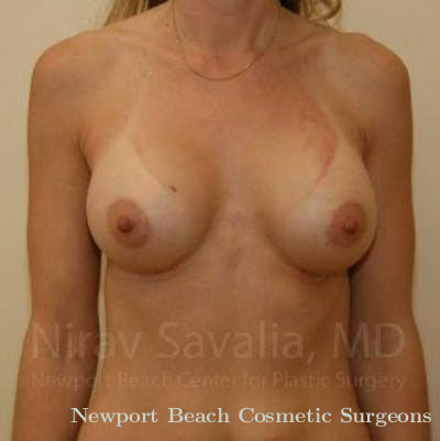 Mastectomy Reconstruction Revision Before & After Gallery - Patient 1655442 - After