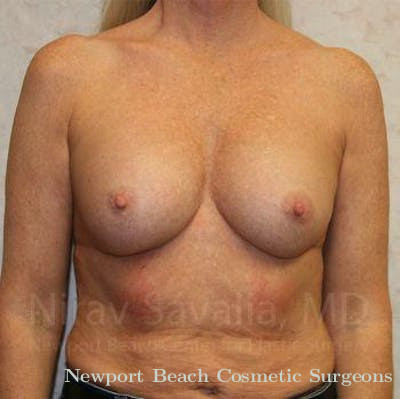 Breast Reduction Before & After Gallery - Patient 1655444 - Before
