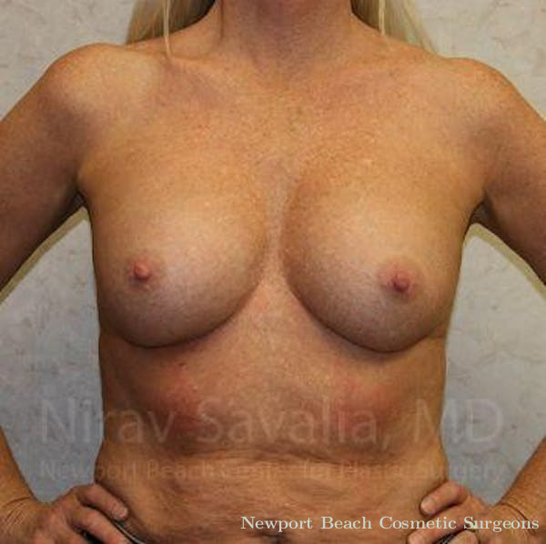 Breast Implant Revision Before & After Gallery - Patient 1655444 - Before