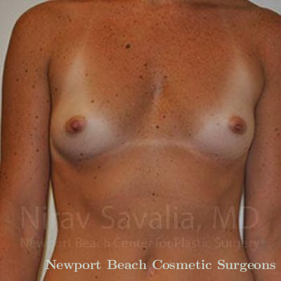 Breast Implant Revision Before & After Gallery - Patient 1655445 - Before