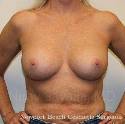 Chin Implants Before & After Gallery - Patient 1655444 - After