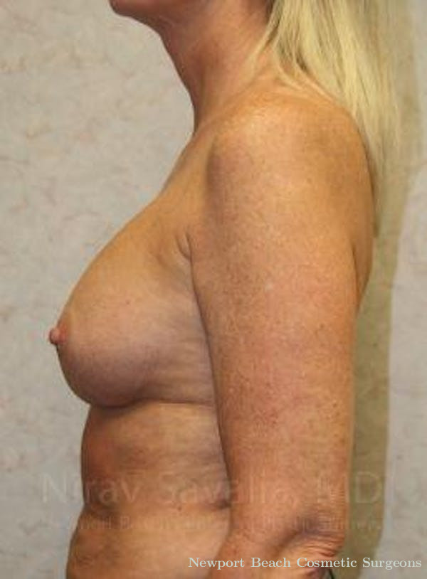 Mastectomy Reconstruction Revision Before & After Gallery - Patient 1655444 - Before