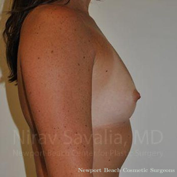 Mastectomy Reconstruction Before & After Gallery - Patient 1655445 - Before