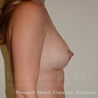 Male Breast Reduction Before & After Gallery - Patient 1655445 - After