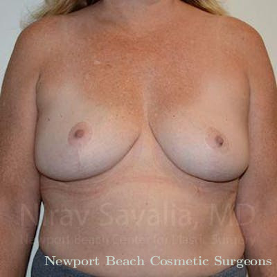Breast Implant Revision Before & After Gallery - Patient 1655446 - After