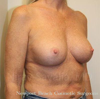 Breast Lift with Implants Before & After Gallery - Patient 1655444 - After